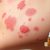 Wyprysk alergiczny: objawy, przyczyny i sposoby leczenia